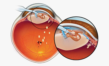 Cataract Treatment
